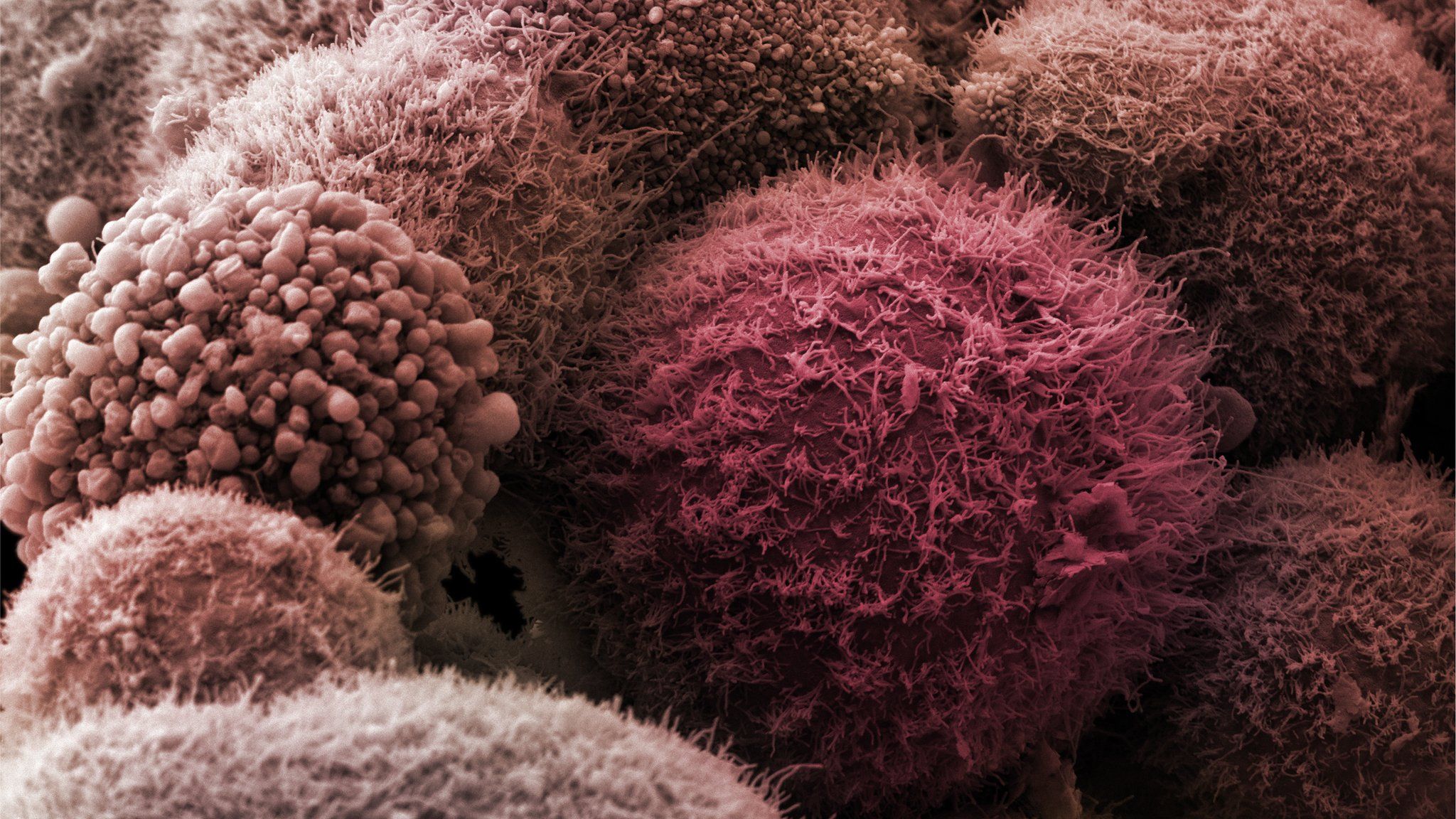 Что такое онкология. Раковые клетки под микроскопом. Опухолевые клетки микроскоп.