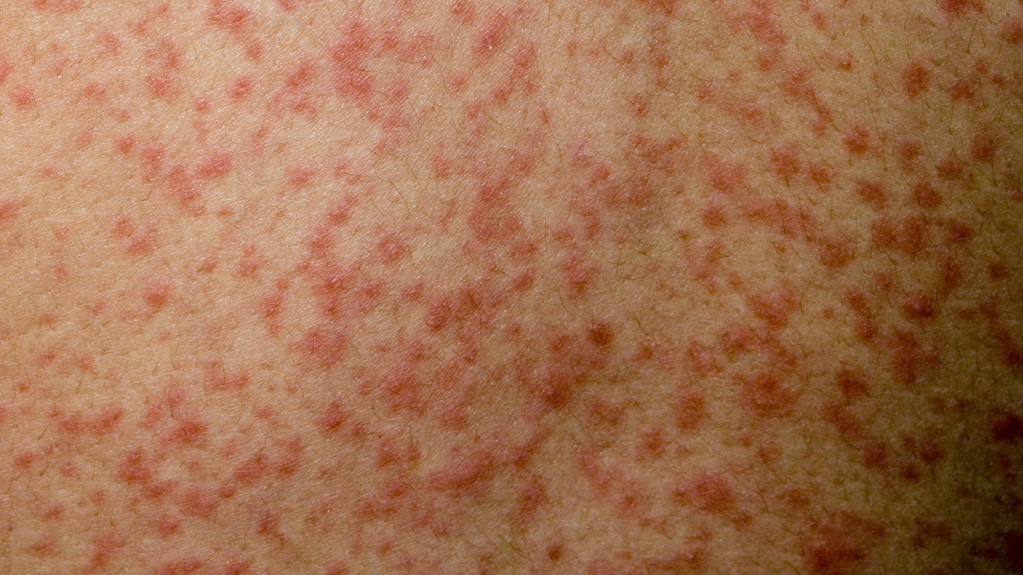 Measles