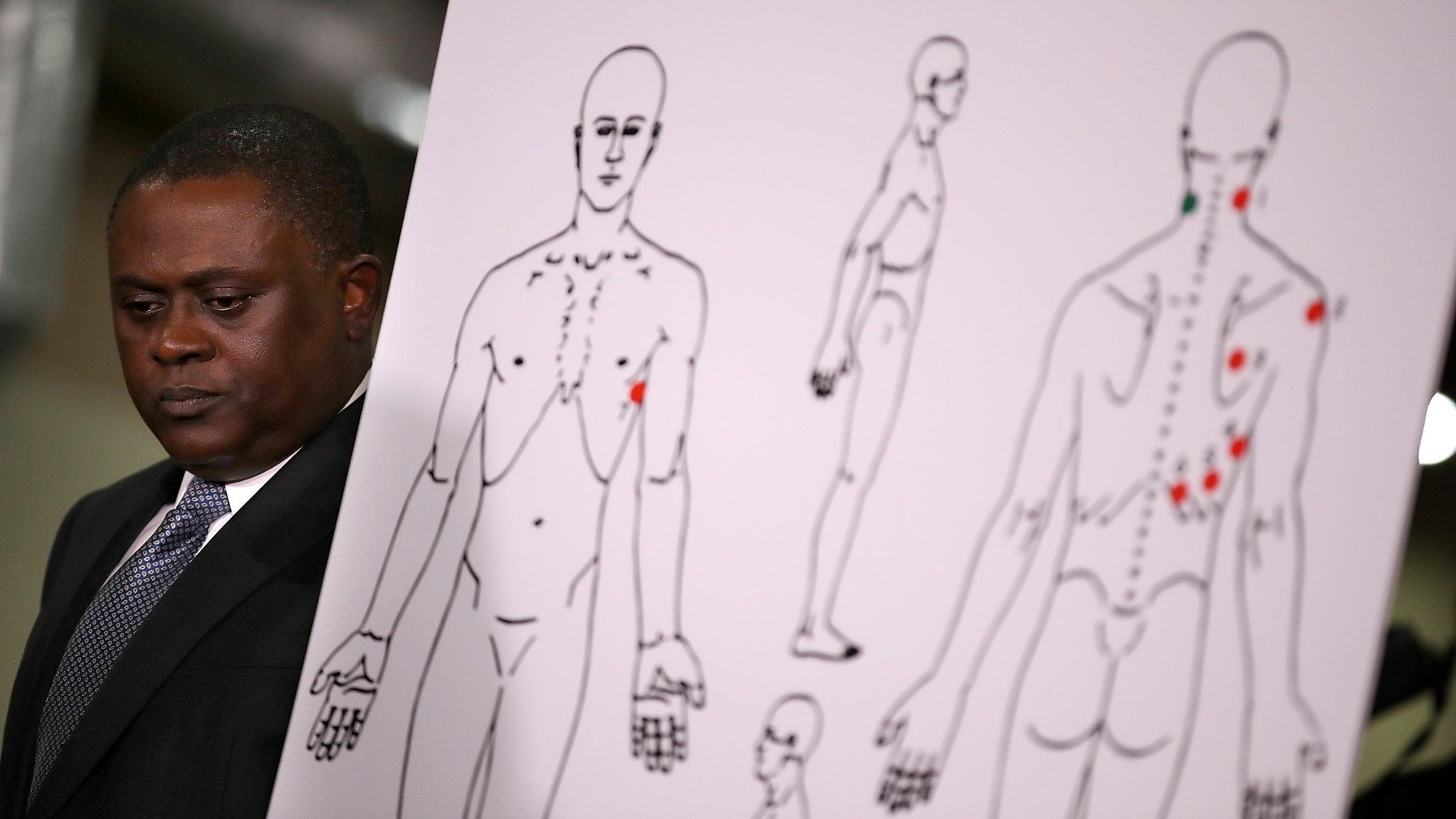Dr. Bennet Omalu stands by a diagram showing the results of his autopsy of Stephon Clark