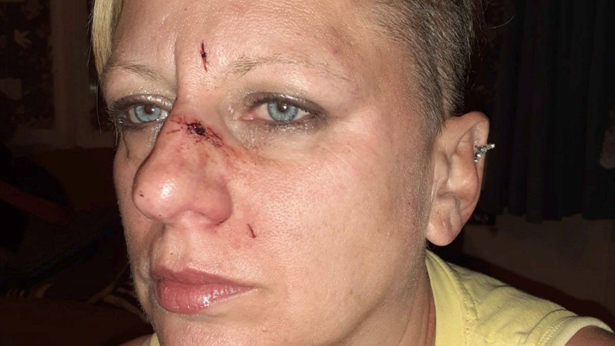 Anne-Marie Daniels's cut face after the incident