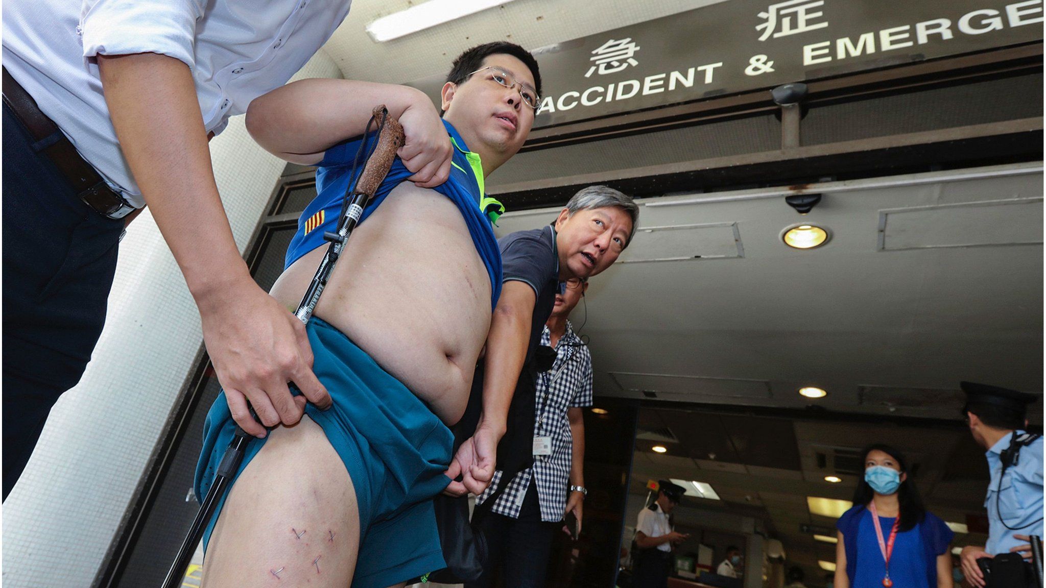 Hong Kong pro-democracy activist Howard Lam (L), who claims he was abducted, blindfolded and beaten by mainland China agents, shows his stapled thighs and injuries to the media in Hong Kong on 11 August 2017