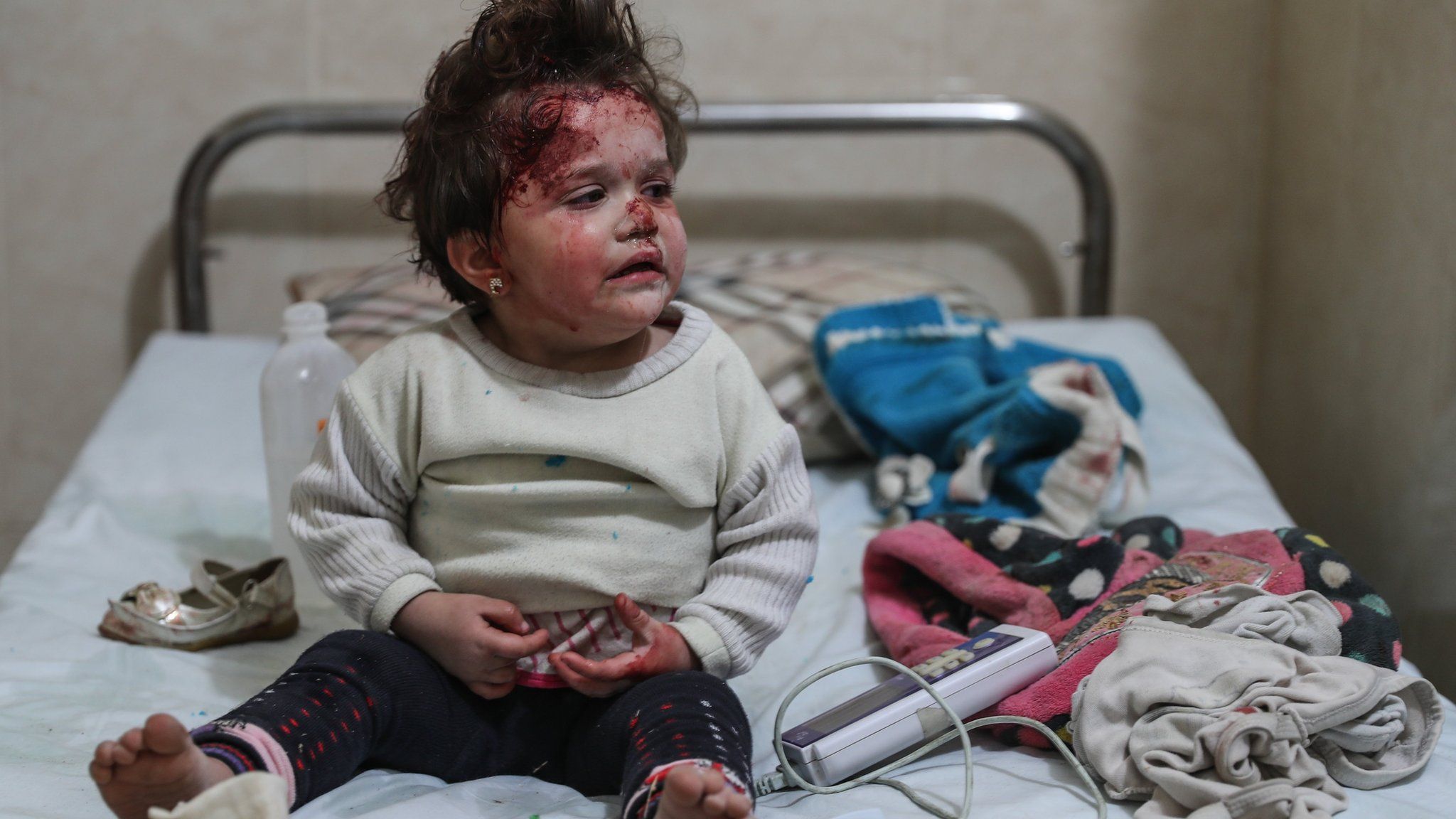 A young girl is treated at a hospital after a bombing in Mesraba, Eastern Ghouta, Syria, 3 January 2018