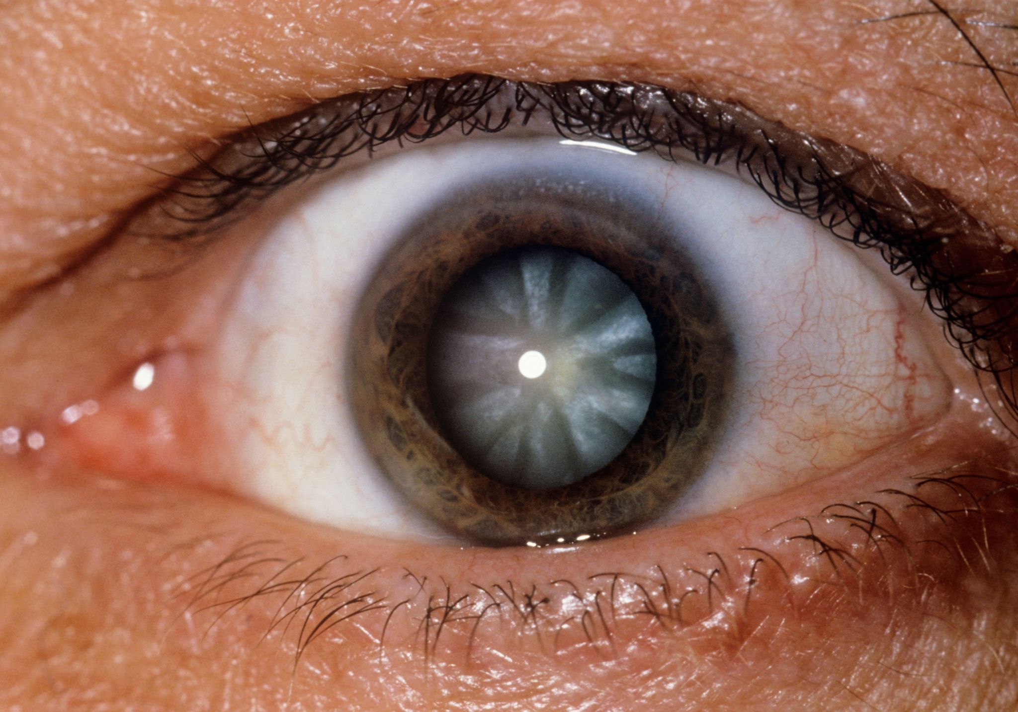 Close-up of the eye showing a cataract, an opacity in the lens of the eye that results in blurred vision