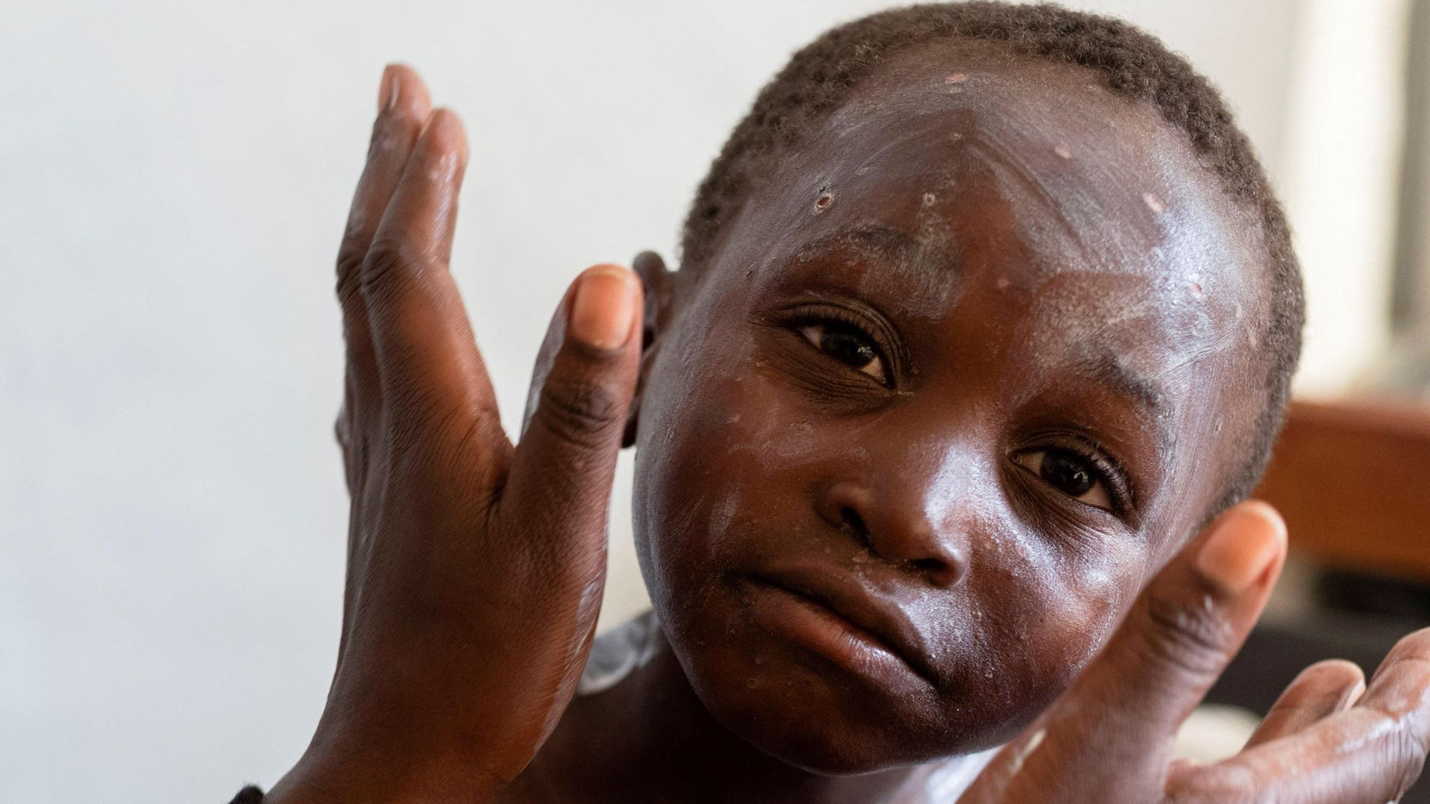 Medication applied to the face of a child with mpox - an infectious disease leading to a painful rash - at a health centre in Munigi, Nyiragongo territory, near Goma in North Kivu province of the Democratic Republic of Congo.