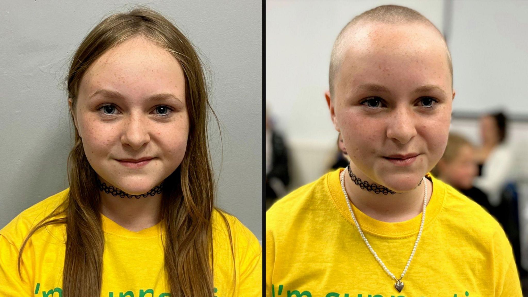 A girl before and after a charity head shave, wearing yellow t-shirt