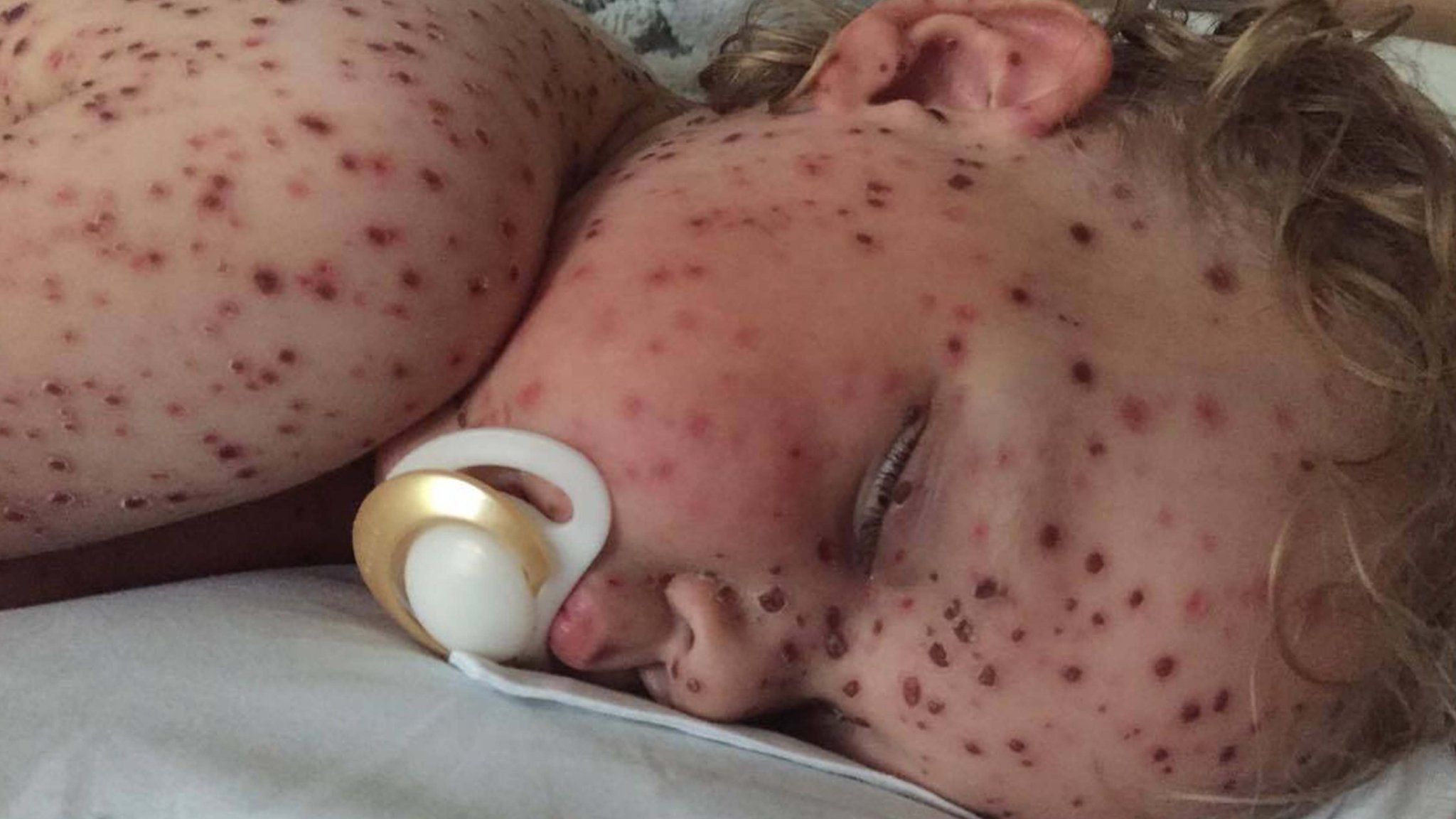 Two-year-old Jasper with chickenpox