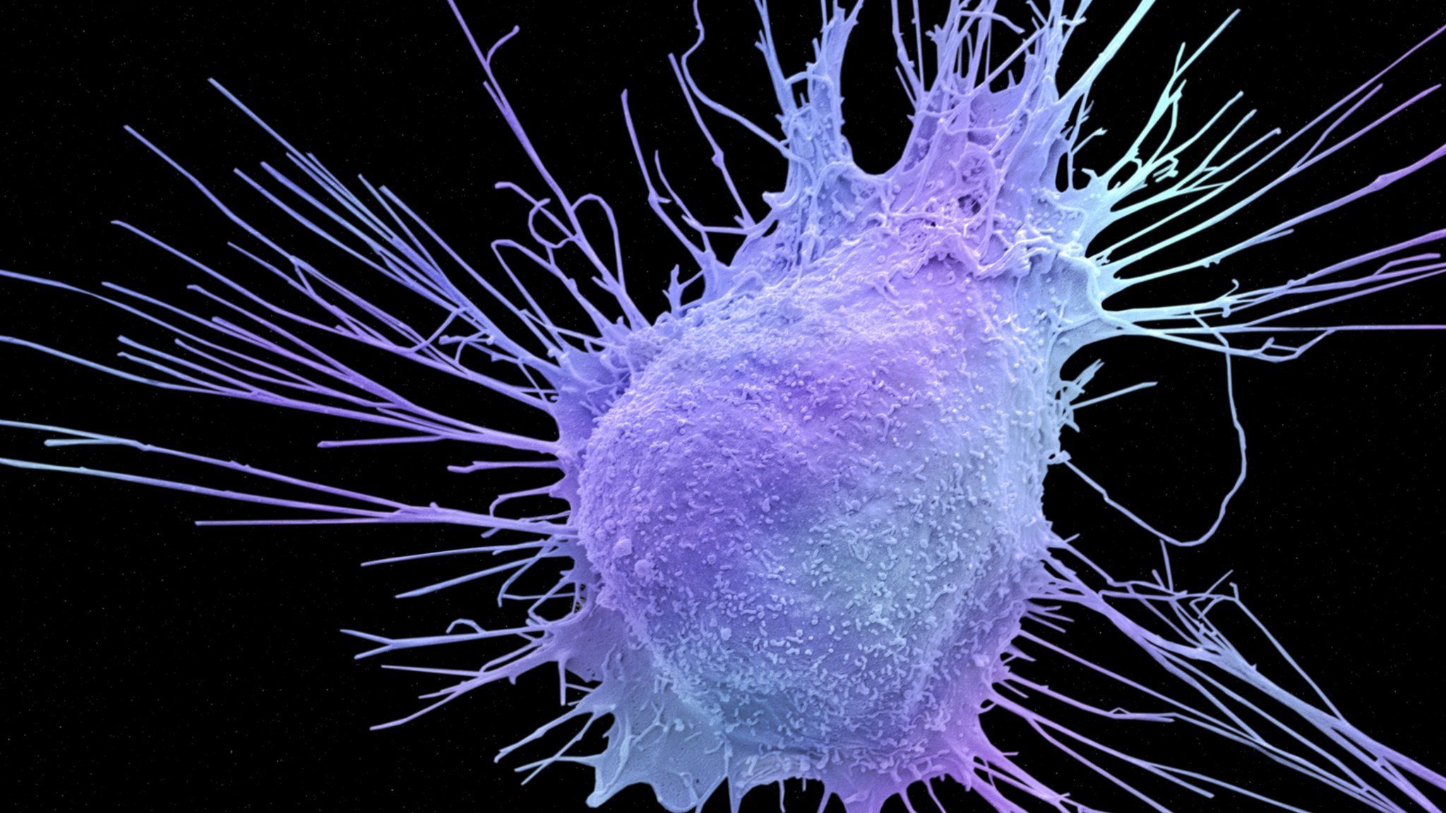 Prostate cancer cell