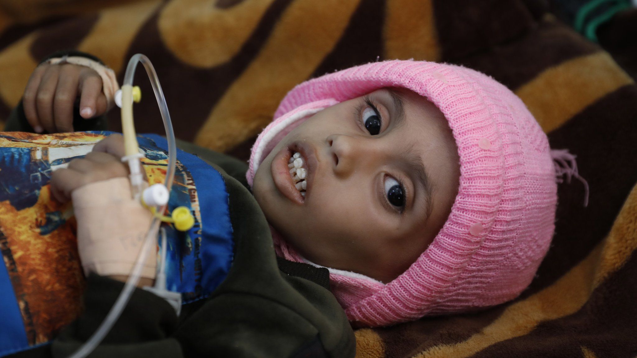 A malnourished child at a hospital in the rebel-controlled Yemeni capital, Sanaa (13 January 2021)