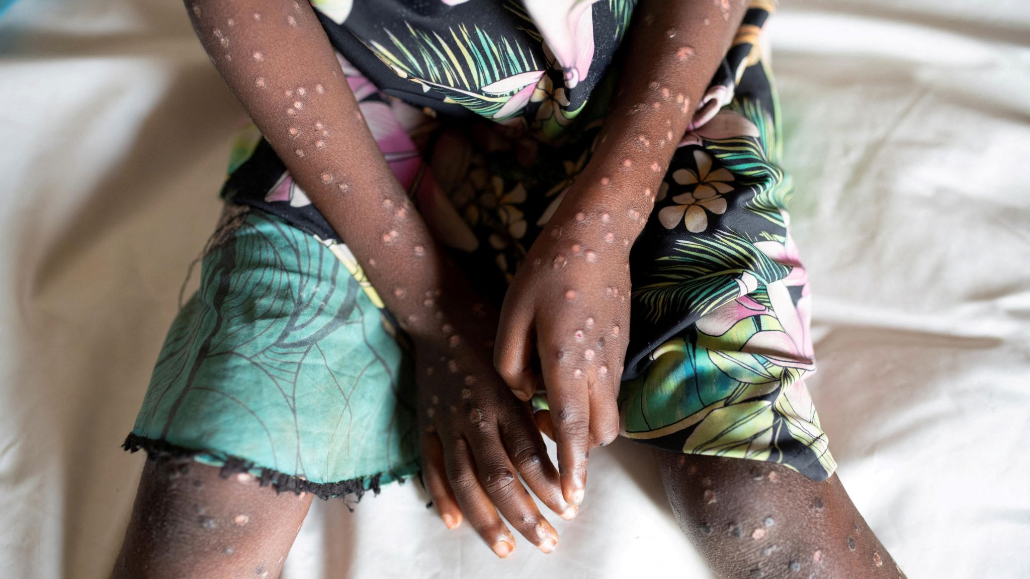 A young girl with mpox lesions on her arms and legs during an outbreak in DR Congo in 2022