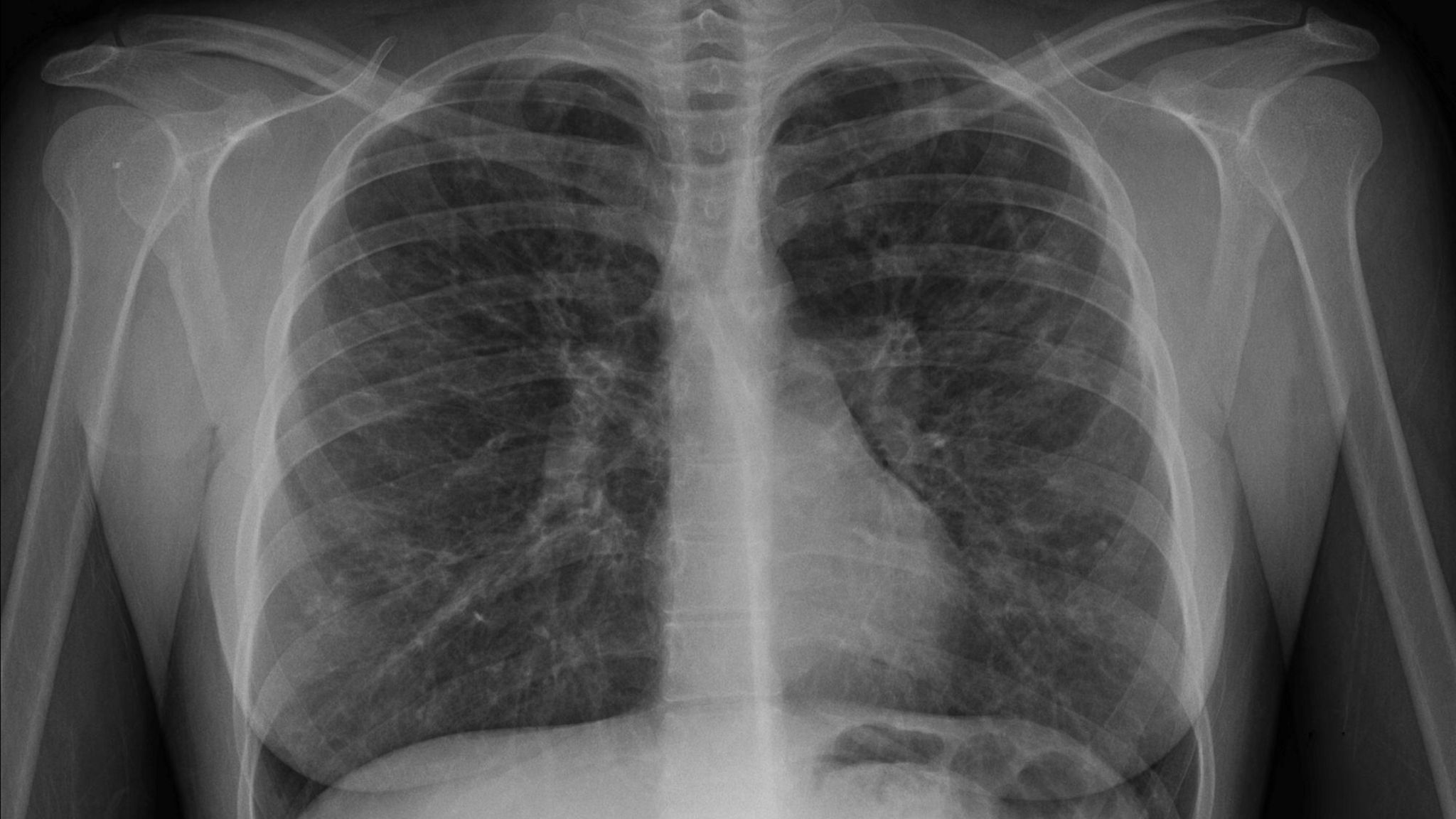 An X-Ray image of someone with cystic fibrosis