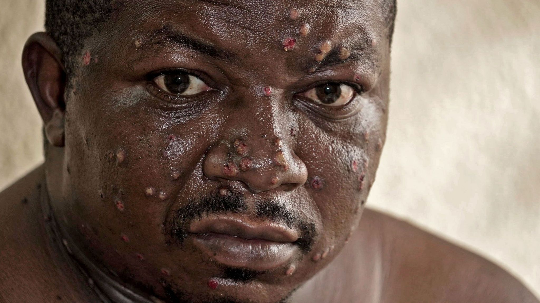 A man who has mpox on his face