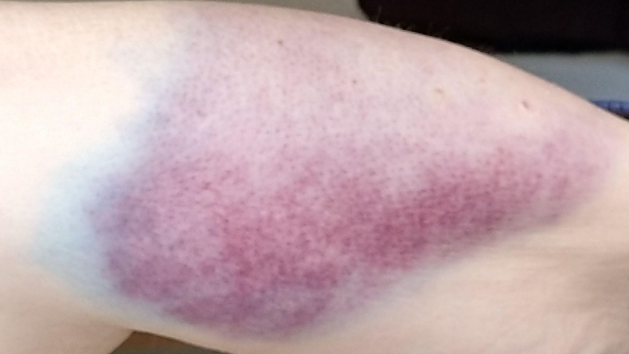 A bruise on an arm