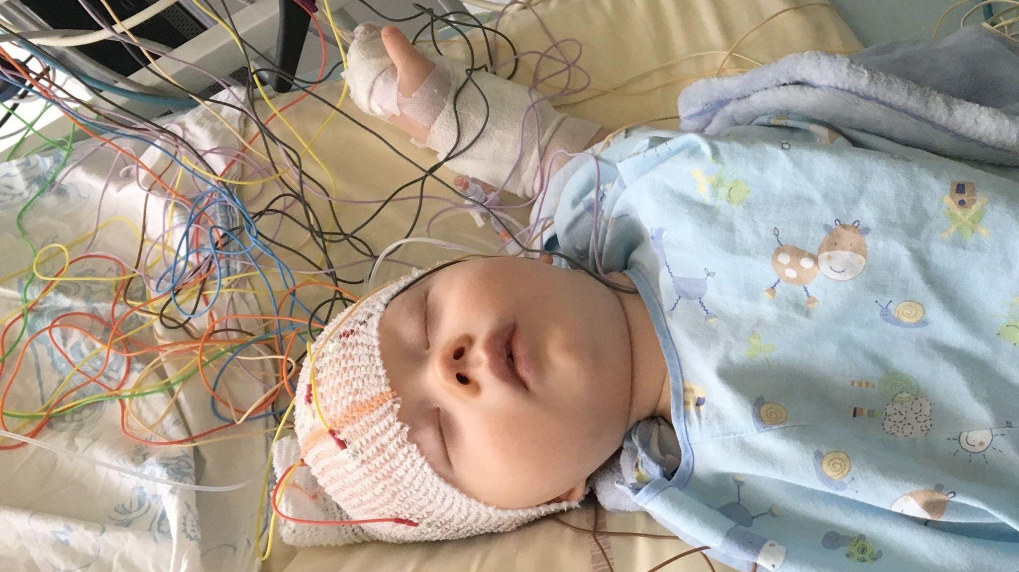 Baby Henry asleep in a hospital bed with multiple coloured wires attached with a bandage around his head