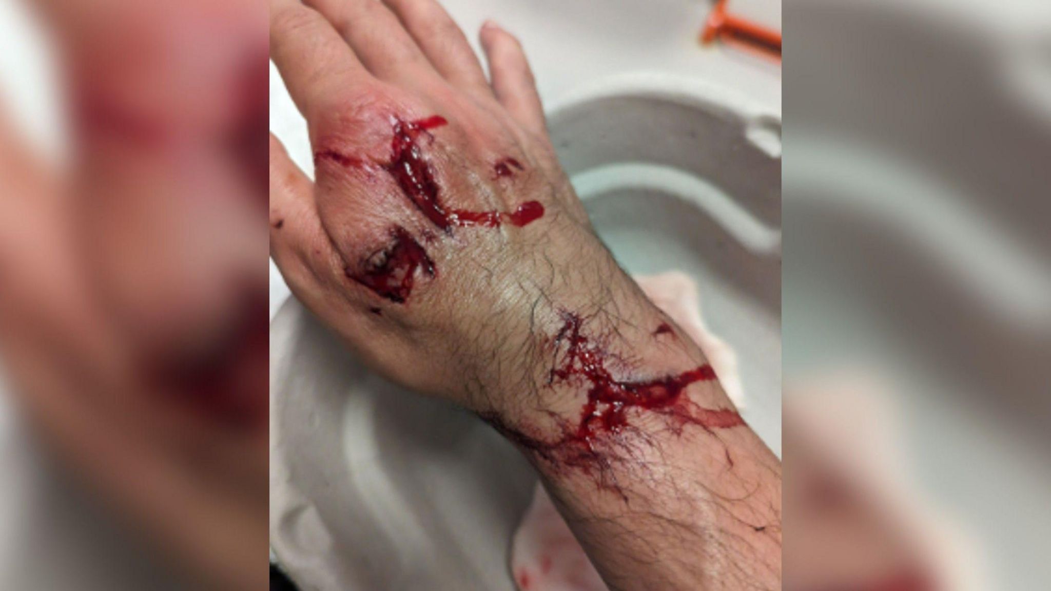 Photo showing Mr Ramirez' wounded right hand 