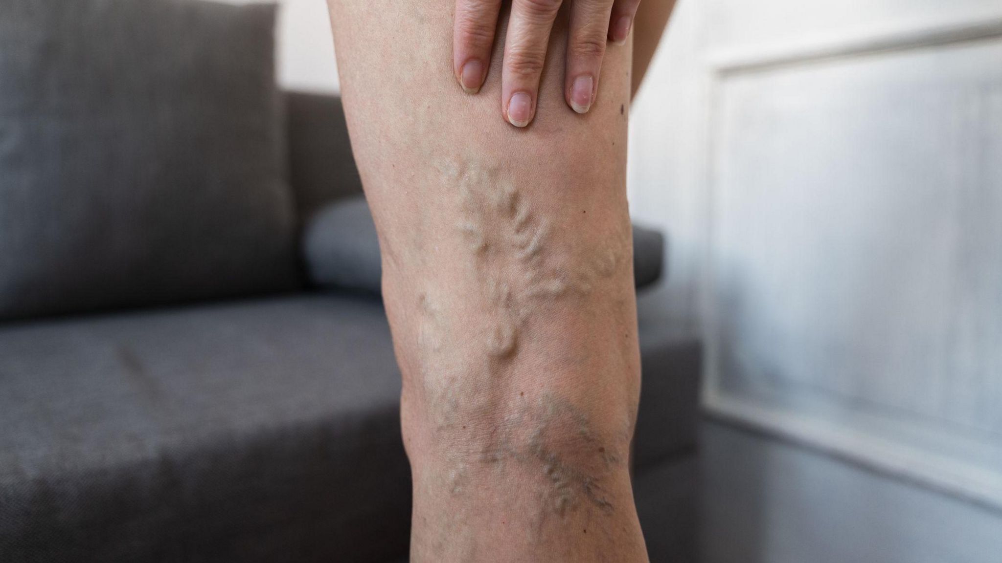 A close up of the back of a woman's leg, with her hand resting on her thigh. You can see swollen and raised veins in a twisting pattern behind her knee.