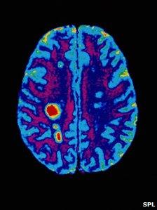 Brain scan of MS patient