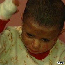 Natalka Kudrikova was severely burned in an arson attack, Czech Republic