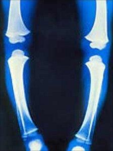 Coloured X-Ray of the legs of a child with rickets