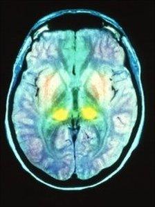 MRI of CJD brain scan