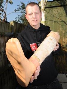 Stuart Hughes and his original prosthetic leg