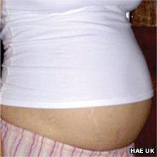 An example of gastrointestinal swelling