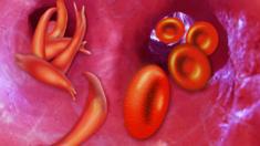 illustration of crescent-shaped sickle cells and normal round red blood cells