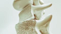Imagem representando uma parte do osso danificada pela osteoporose