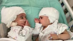 В Ізраїлі розділили з'єднаних головами близнят