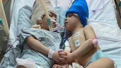 Conjoined twins separated with virtual reality
