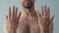 Homem mostra as mãos com lesões típicas da varíola dos macacos