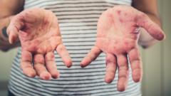 Foto mostra as mãos e parte do tronco de uma mulher. A pele apresenta manchas avermelhadas sugestivas de sarampo