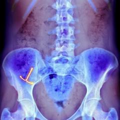 Descubre los curiosos objetos y animales dentro del cuerpo humano 2 Una radiografía muestra un dispositivo anticonceptivo intrauterino en el vientre de una mujer