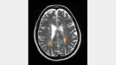 मल्टीपल स्क्लेरोसिस: दिमाग़ और रीढ़ की हड्डी पर वार करने वाली बीमारी की रोकथाम क्या संभव है- दुनिया जहान