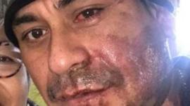 El ataque con ácido contra un hombre de origen peruano que se juzga como crimen de odio en EE.UU.