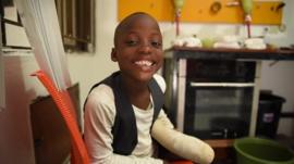 A young boy with a prosthetic limb