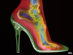 X-ray of woman wearing high heels