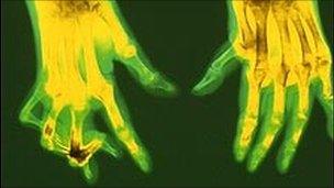 An X-ray of hands affected by rheumatoid arthritis