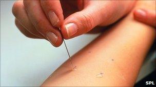 Child undergoing a skin prick test for allergies