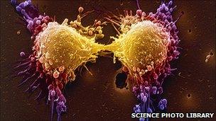 Coloured scanning electron micrograph (SEM) of two prostate cancer cells in the final stage of cell division (cytokinesis)