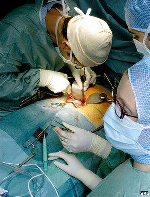 Kidney transplant