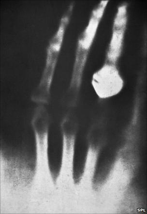 The first X-ray photograph of a human being. The picture was made by Wilhelm Roentgen shortly after his discovery of X-rays in 1895. It shows the hand of his wife, who is wearing a ring.