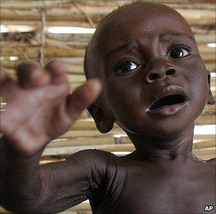 A malnourished child (Image: AP)
