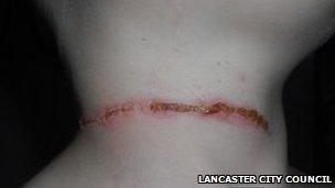 Isaac Hargreaves' scar