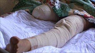 Yasser al-Anbari's injuries, caused by a sticky bomb
