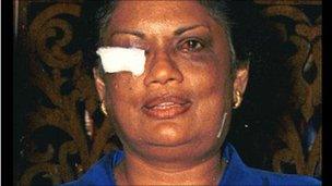 Chandrika Kumaratunga after the attack on her rally in Colombo in 1999