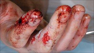 hand injury caused by firework