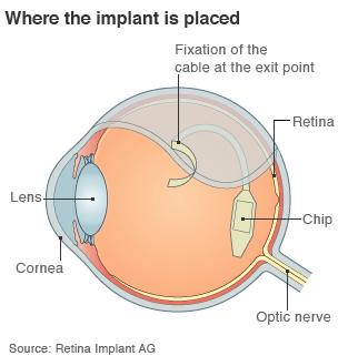 Where the retina implant is placed