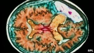 Brain scan showing a stroke