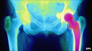 coloured X-ray of an artificial hip