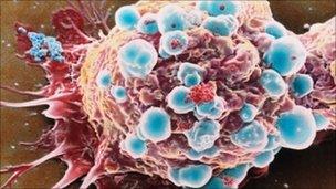 Раковая клетка молочной железы